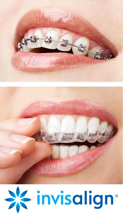 Invisalign : Orthodontie et appareil dentaire invisible - GUIDE